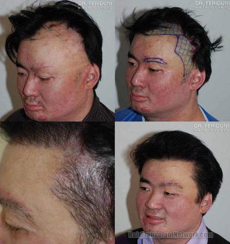 Left  oblique before and after hair restoration on burn victim