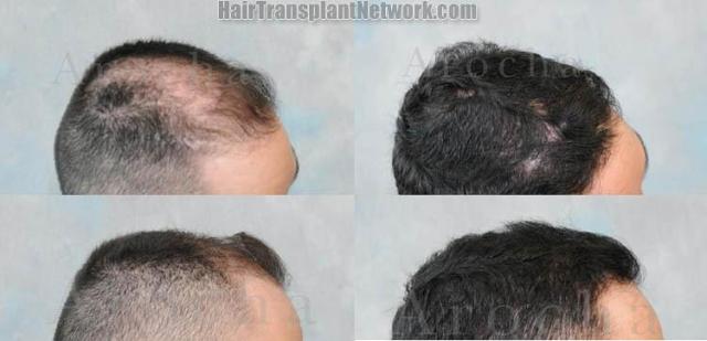 Right view before and after hair restoration procedure