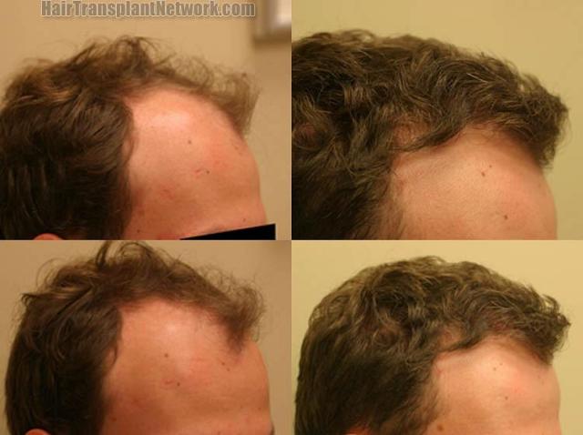 Hair restoration procedure before and after results