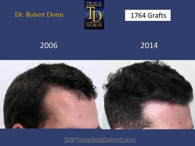 Hair transplantation surgery before and after images