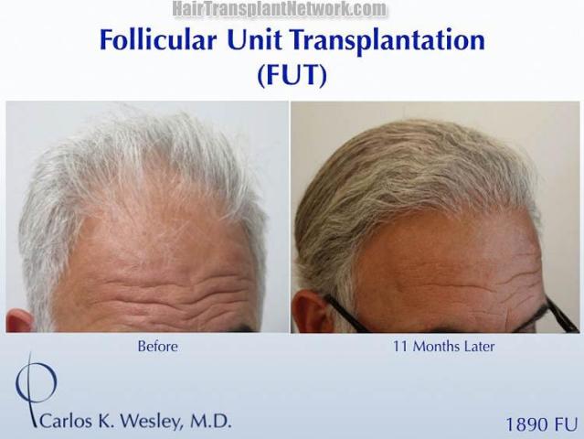 Hair transplantation surgery before and after images