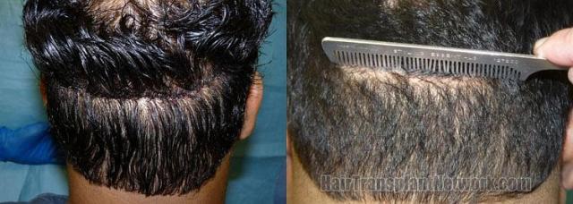 Hair transplant residual donor scar photographs