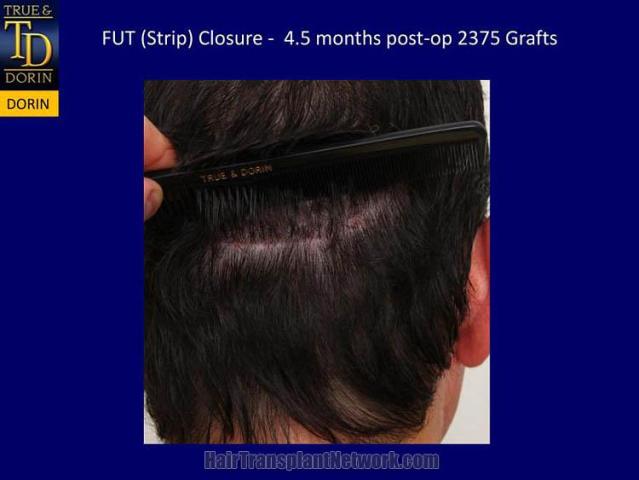 Hair restoration procedure before and after pictures