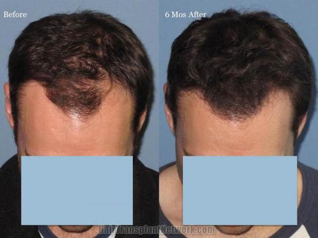 Hair transplantation surgery before and after images