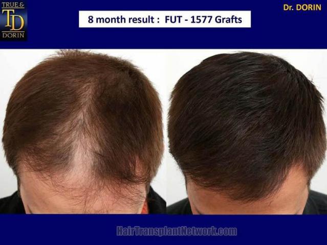 Top view - Before and after hair restoration result