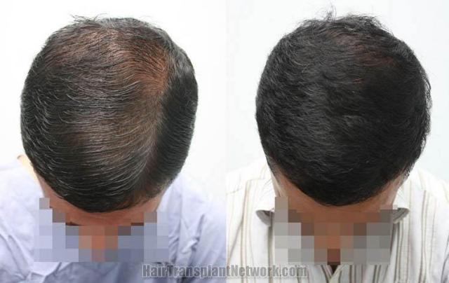 Hair restoration procedure before and after pictures