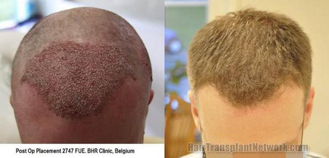 Hair transplantation surgery before and after photos