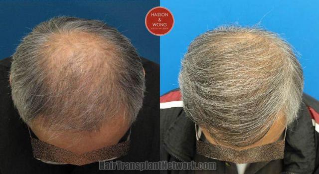 Hair transplantation surgery before and after photos