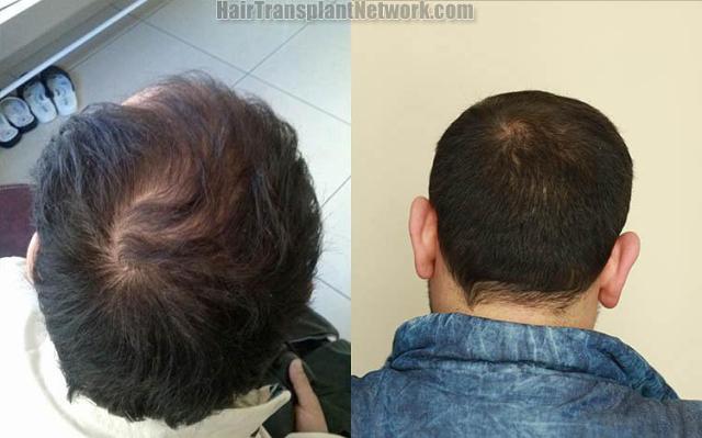 Hair transplant surgery before and after photos