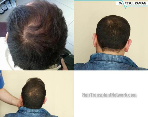 Hair restoration procedure before and after pictures