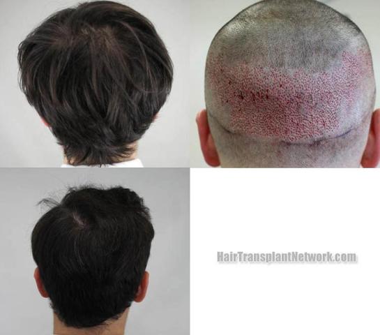 Hair replacement surgery before and after images