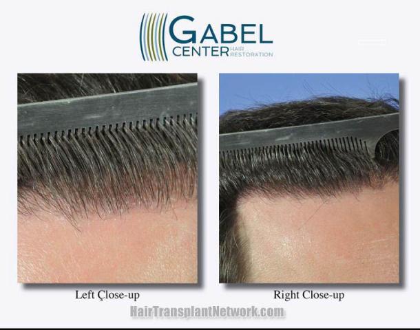 Hair transplant surgery before and after photos