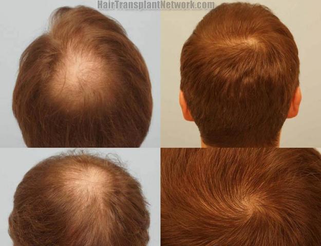 Hair transplantation surgery before and after images