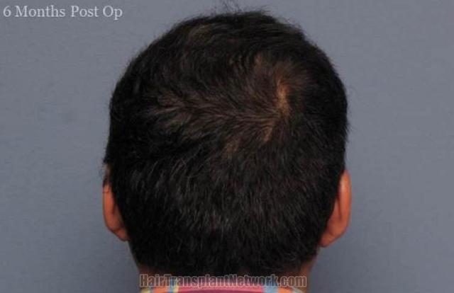 Hair restoration surgery before and after photos