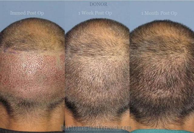 Back view before and after hair transplantation photos