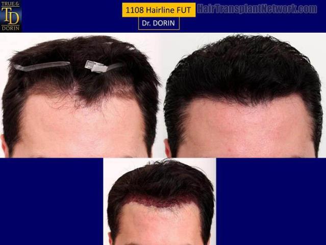 Hair restoration procedure before and after results