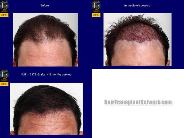 Hair restoration procedure before and after results