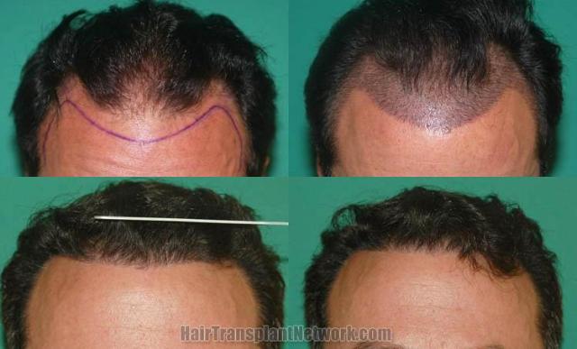 Hair transplantation surgery before and after photos