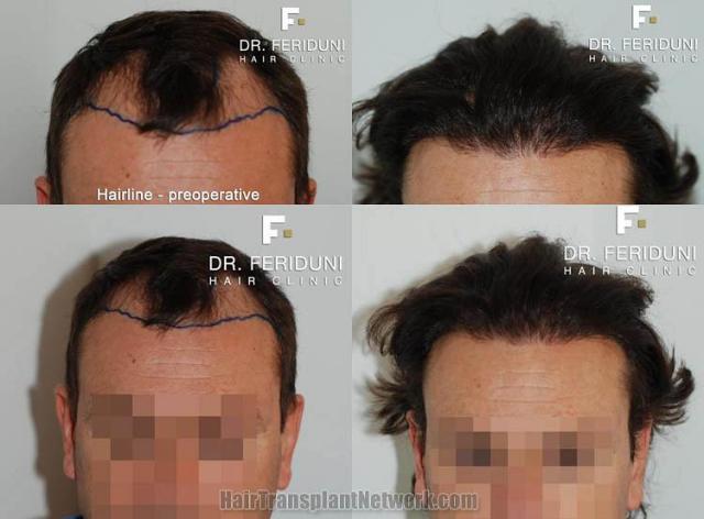 Hair restoration procedure before and after results