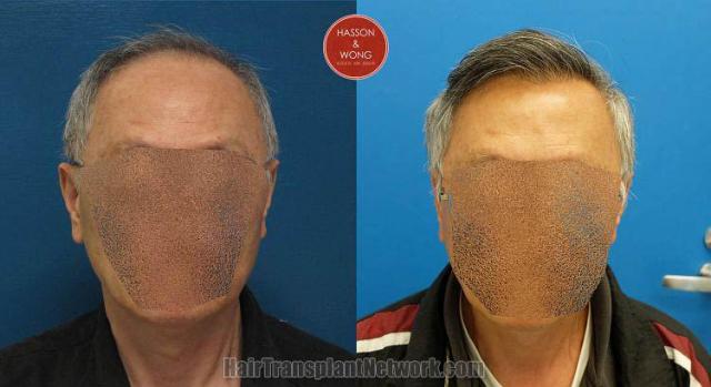 Hair restoration procedure before and after results