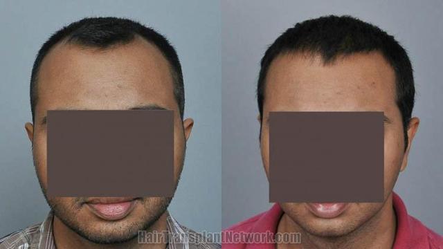 Hair restoration procedure before and after results