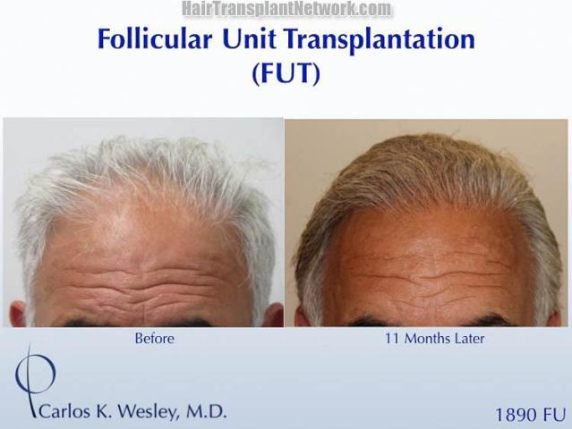 Hair restoration procedure before and after results