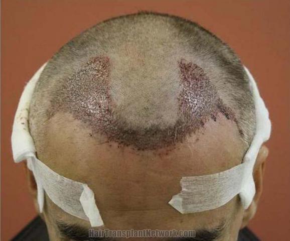 Hair transplantation surgery before and after images