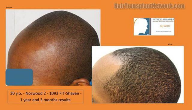 Hair transplantation surgery before and after pictures