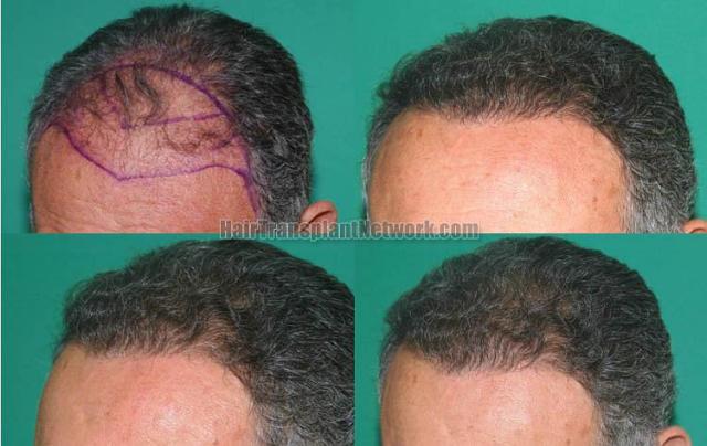 Hair restoration procedure before and after pictures