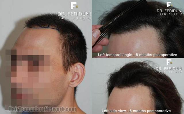 Hair transplantation surgery before and after pictures