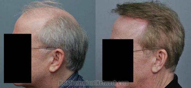 Hair transplantation surgery before and after images