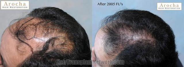 Hair restoration procedure before and after pictures