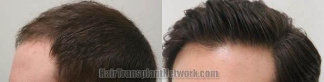 Hair transplantation surgery before and after pictures