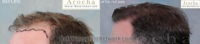 Hair transplantation surgery before and after pictures