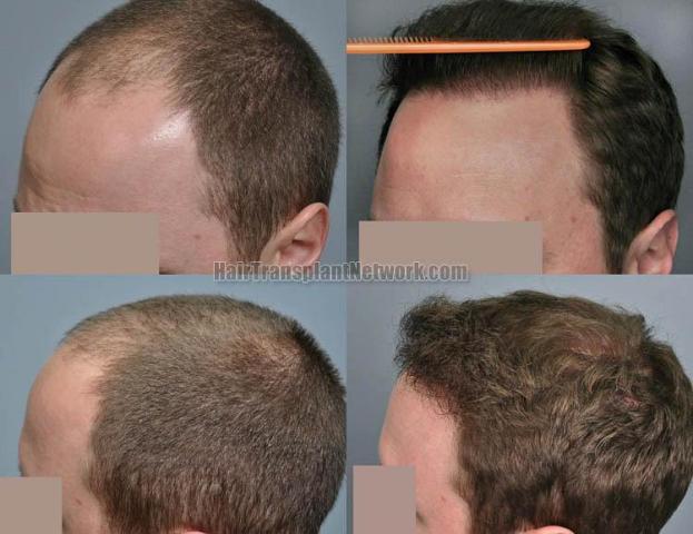 Hair transplantation surgery before and after pictures