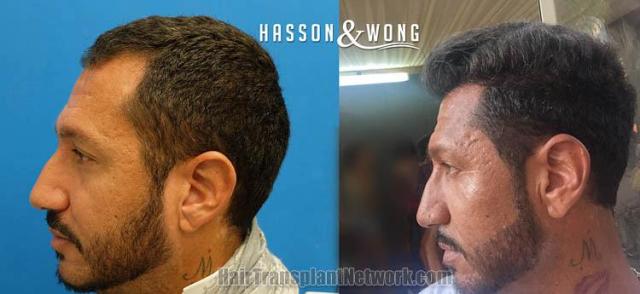 Hair transplantation surgery before and after pictures