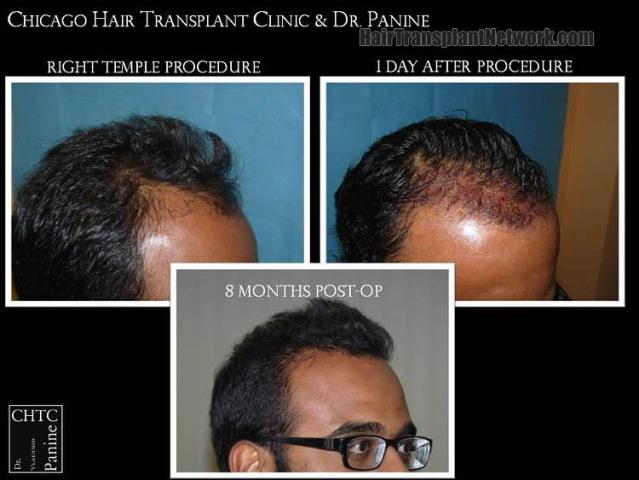 Hair transplantation surgery before and after photos