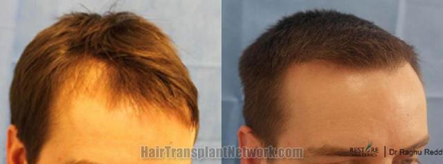 Hair restoration procedure before and after results