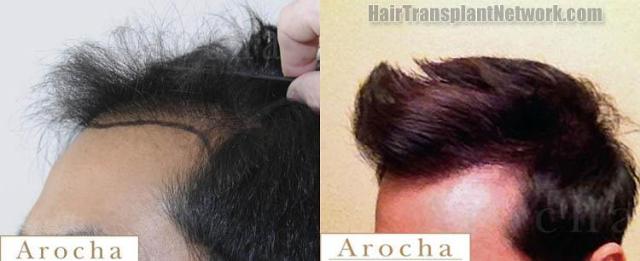 Hair transplantation surgery before and after photos