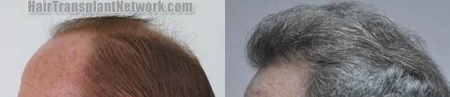 Hair transplantation surgery before and after pictures