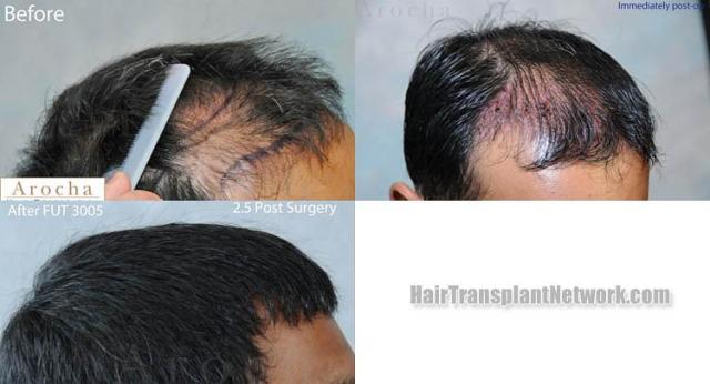 Hair transplantation surgery before and after photos