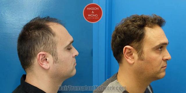 Hair restoration procedure before and after pictures