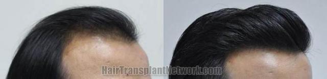 Hair transplantation surgery before and after photos