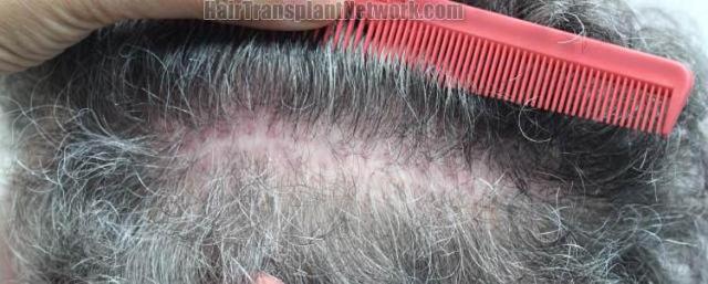 Hair restoration procedure before and after pictures