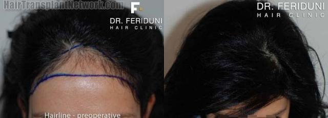 Top view before and after hair restoration results