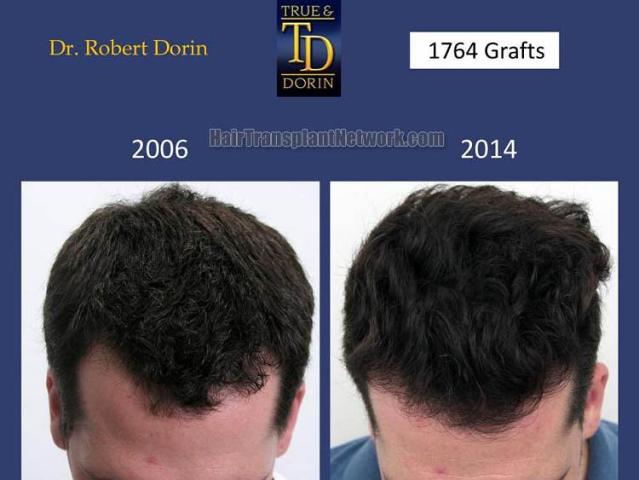 Top view before and after hair restoration results