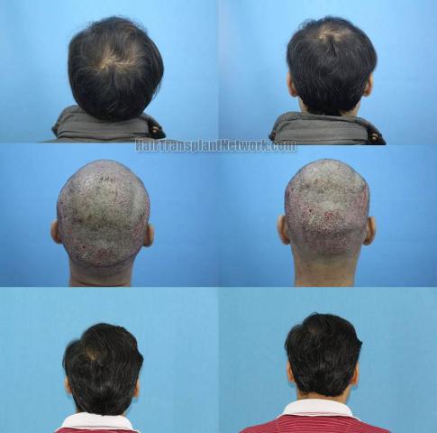 Hair replacement surgery before and after images