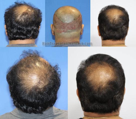 Hair replacement surgery before and after images