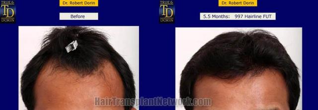 Hair restoration procedure before and after results