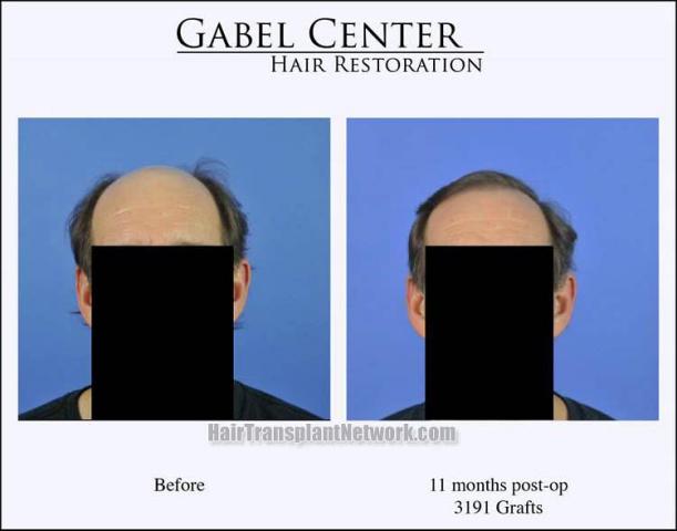 Hair restoration procedure before and after results